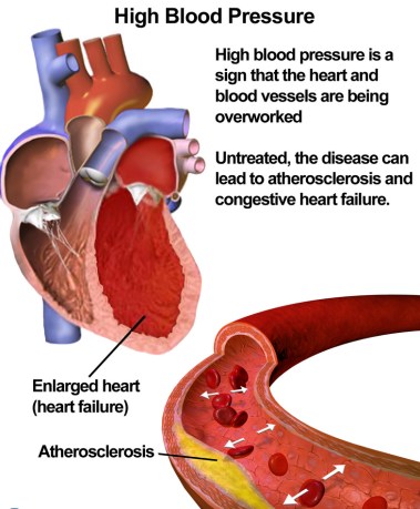 HypertensionAtherosclerosis