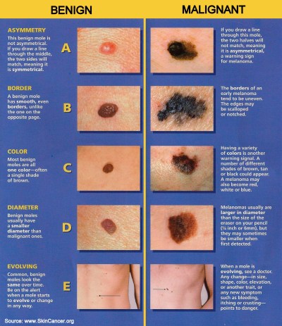 SkinCancerDetectionGuide2