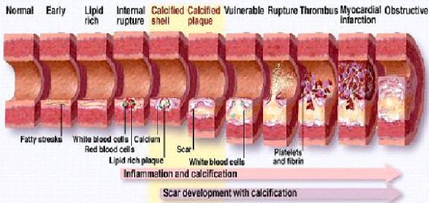 HeartAttackPimpleAnalogy