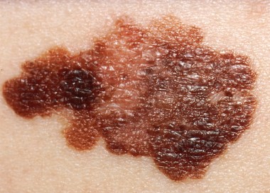 Melanoma2